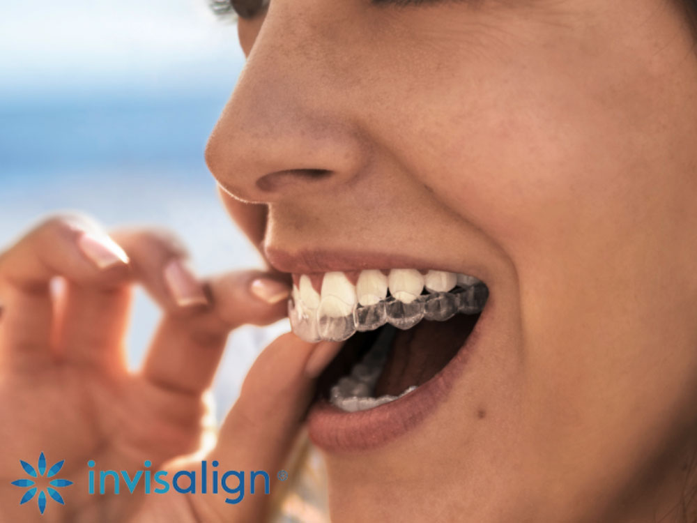 invisalign